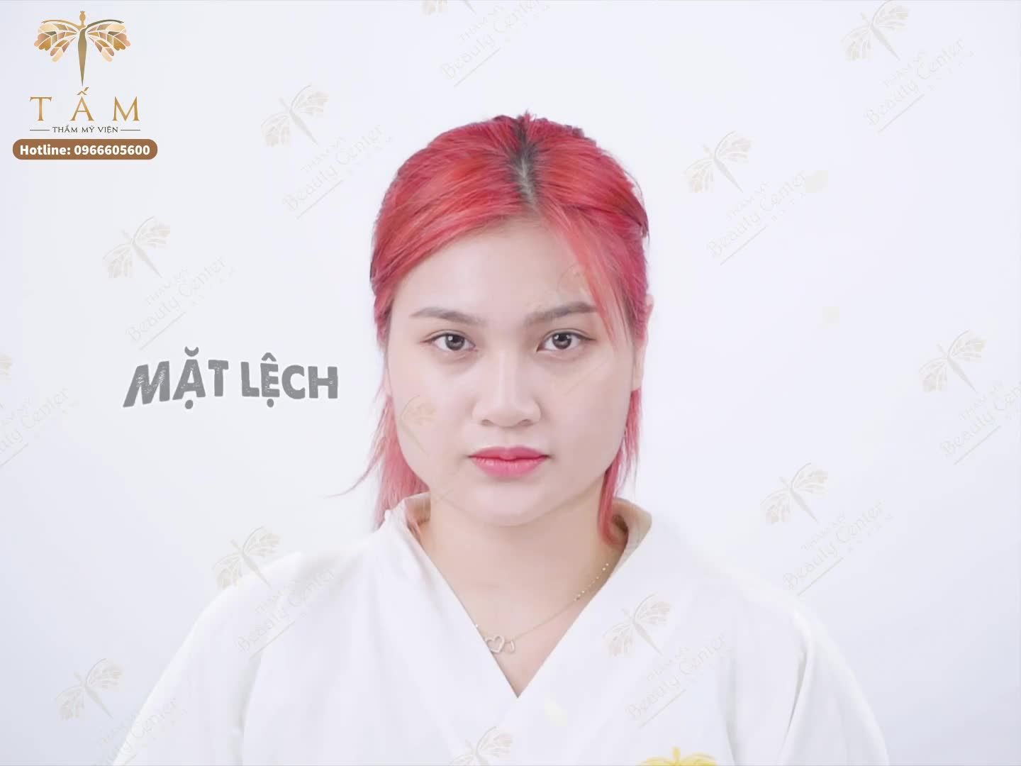 Thon gọn hàm không phẫu thuật hiệu quả hơn 68% so với tất cả phương pháp làm gọn hàm thông thường khác